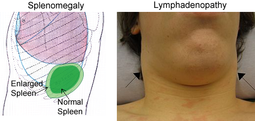 side-by-side image displaying an enlarged spleen and enlarged lymphnodes.