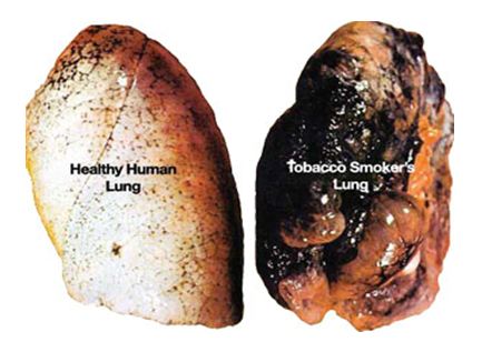 clean lungs and lungs affected by tobacco